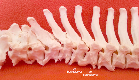 Wervelkolom met ernstige spondylose