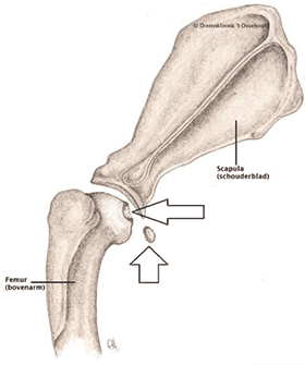 Osteochondrosis Dissecans