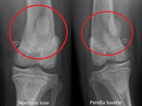 Patella luxatie