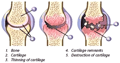 Vorming en verergering van artrose.