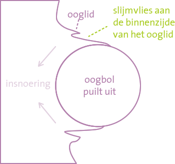 Uitpuilend oog